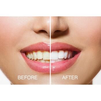 Rio Отбеливание зубов DCWU-EU/1,6, 15мин, 20 процедур, 1 насадка, 16 LED, Blue-Light Teeth Whitening™ (DCWU-EU/1,6)